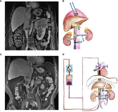 PUTH Grading System for Urinary Tumor With Supradiaphragmatic Tumor Thrombus: Different Surgical Techniques for Different Tumor Characteristics